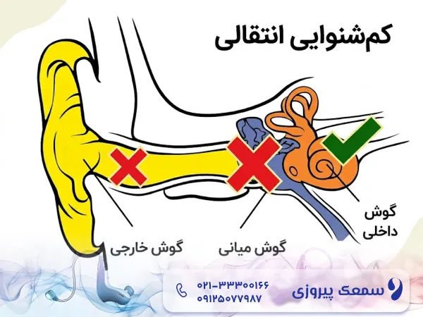 کم شنوایی انتقالی